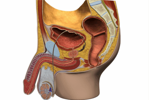 Prostate enlargement (BPH)