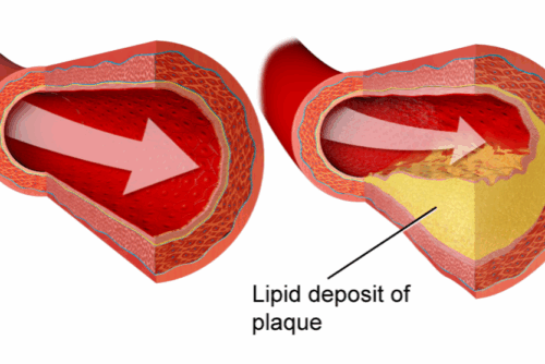 Coronary_Artery_Disease (1)