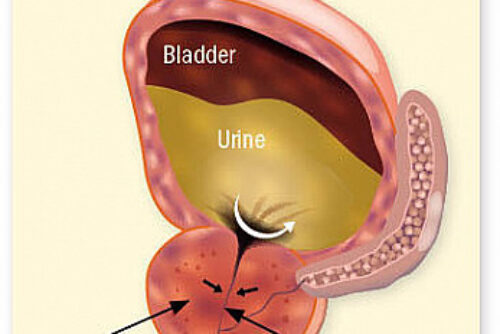 enlarged prostate 2